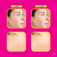 Cargar imagen en el visor de la galería, Serum Facial Con Acido Salicilico Anti Acne Bioaqua OnlyShop Mexico
